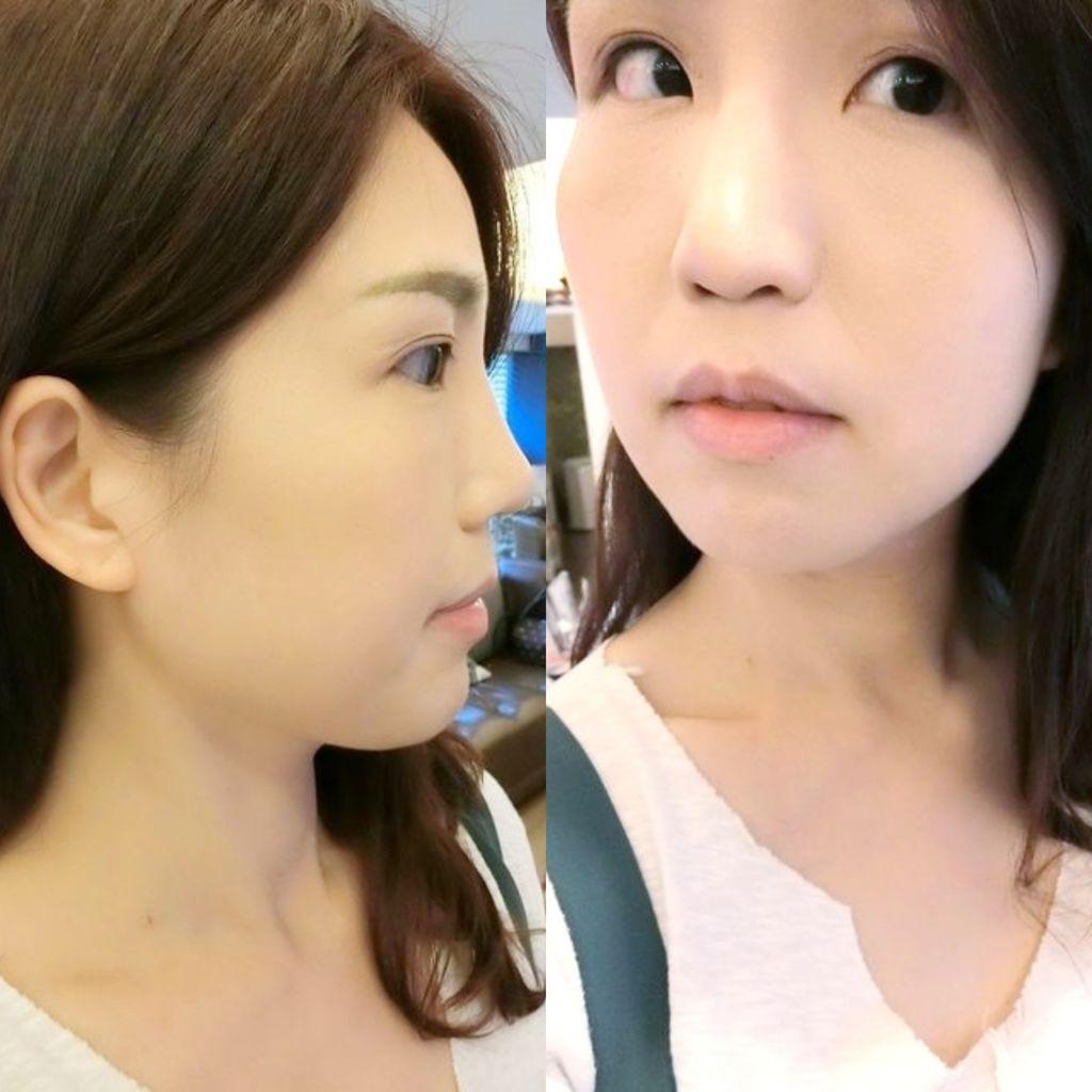 | 玻尿酸隆鼻+肉毒小臉 | 仁愛星和診所 / 東區醫美 / 許源津醫師 專業 .細心服務 玻尿酸+肉毒(打造臉部自然曲線) - 第2張圖 | 玻尿酸隆鼻+肉毒小臉 | 仁愛星和診所 / 東區醫美 / 許源津醫師 專業 .細心服務 玻尿酸+肉毒(打造臉部自然曲線)