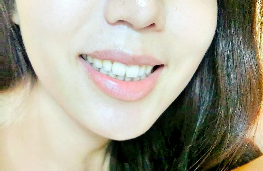 |牙齒診所推薦|御森美學牙醫診所.擁有自信笑容.陶瓷貼片/冷光美白/隱形矯正/無痛微創植牙 - 第3張圖 |牙齒診所推薦|御森美學牙醫診所.擁有自信笑容.陶瓷貼片/冷光美白/隱形矯正/無痛微創植牙