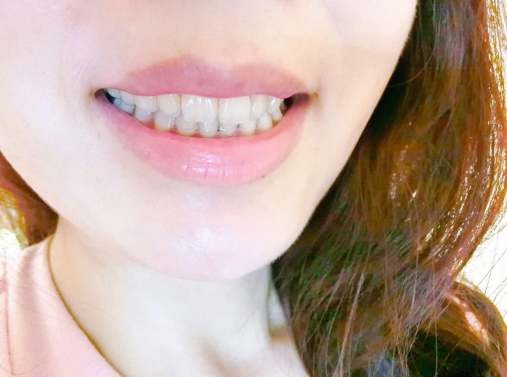 |牙齒診所推薦|御森美學牙醫診所.擁有自信笑容.陶瓷貼片/冷光美白/隱形矯正/無痛微創植牙 - 第24張圖 |牙齒診所推薦|御森美學牙醫診所.擁有自信笑容.陶瓷貼片/冷光美白/隱形矯正/無痛微創植牙