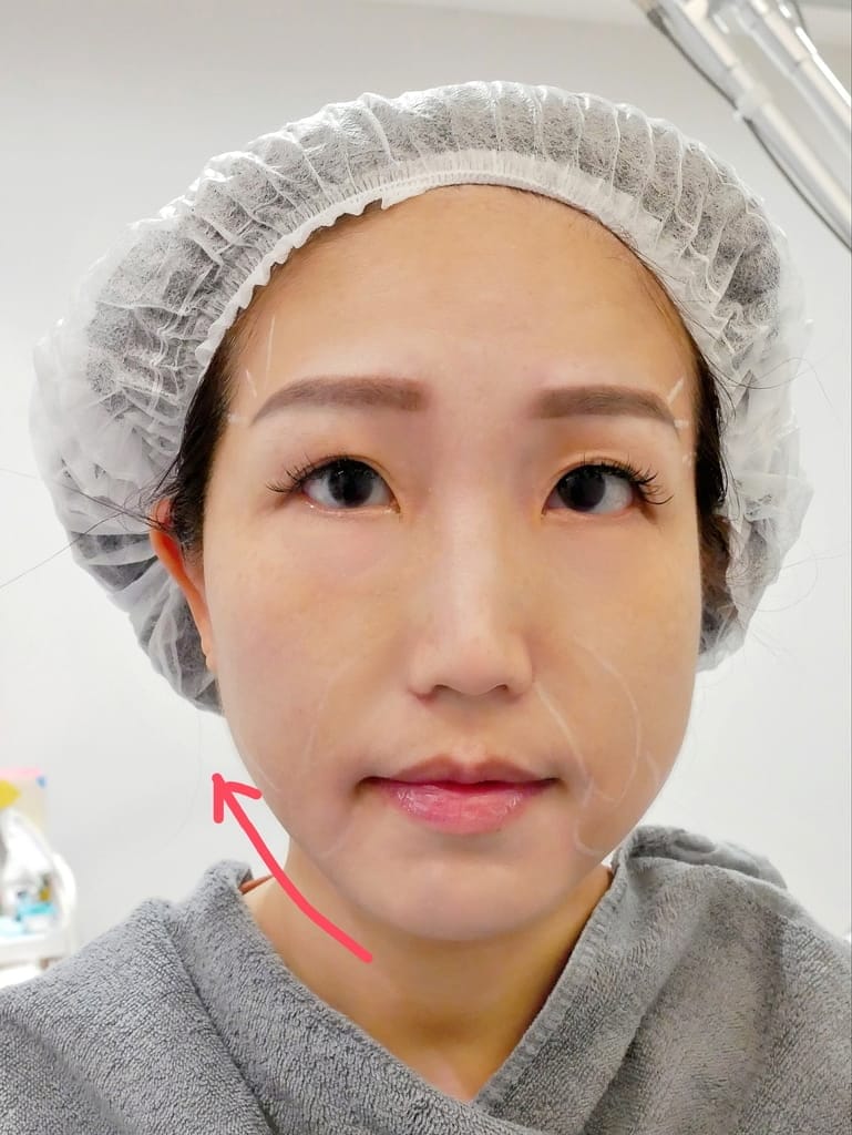 |台北醫美診所推薦|琢美妍時尚診所.LV立特拉音波.林君曄醫師專業有耐心,音波拉提心得分享~ - 第26張圖 |台北醫美診所推薦|琢美妍時尚診所.LV立特拉音波.林君曄醫師專業有耐心,音波拉提心得分享~