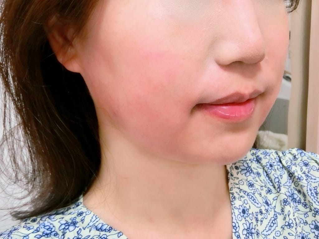 |醫美診所推薦|台北東妍醫美.消脂容脂針注射,打造完美鵝蛋臉.和雙下巴說掰掰~玉媽咪心得分享! - 第25張圖 |醫美診所推薦|台北東妍醫美.消脂容脂針注射,打造完美鵝蛋臉.和雙下巴說掰掰~玉媽咪心得分享!
