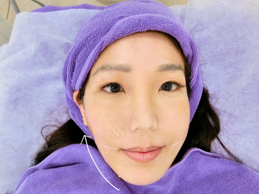 | 台北音波拉提診所分享 | 愛爾麗診所、HIPRO-S 龍捲風音波拉提、打造完美臉部輪廓~ - 第18張圖 | 台北音波拉提診所分享 | 愛爾麗診所、HIPRO-S 龍捲風音波拉提、打造完美臉部輪廓~